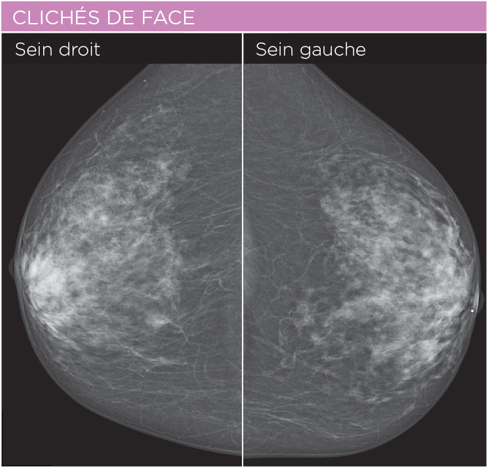 La mammographie - CHL - Maternité