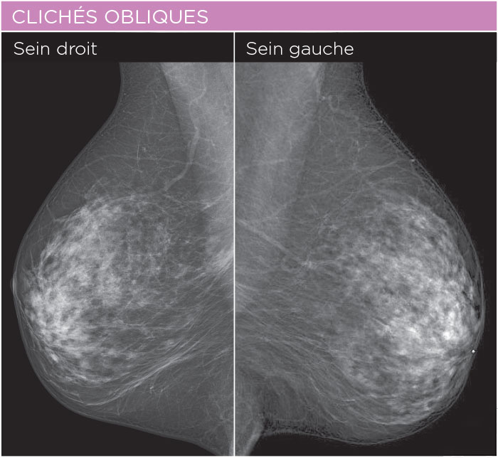 La mammographie | CHL