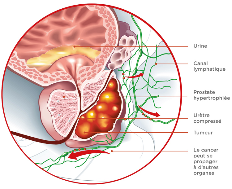 Schéma d'une prostate avec tumeur