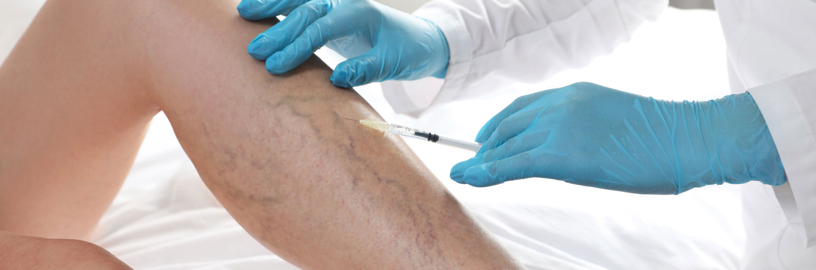 Instructions après consultation - injections varices